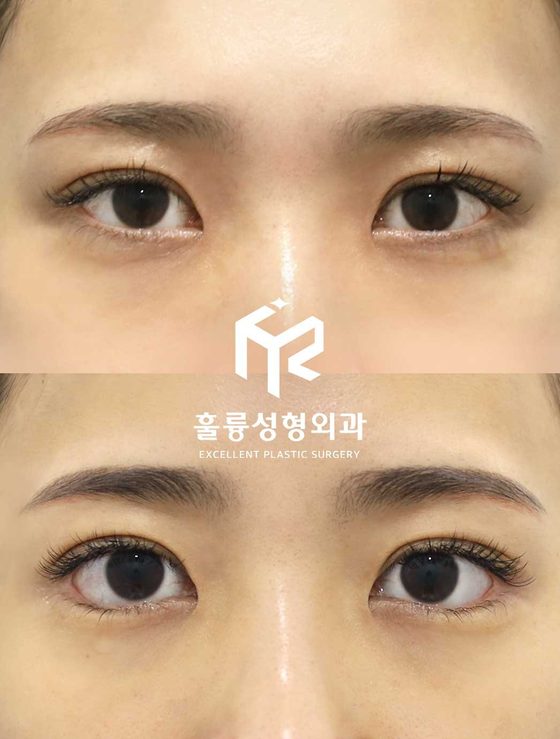 수술 전후 눈 사진(가운데 훌륭성형외과 로고) — 그림 속 글 없음