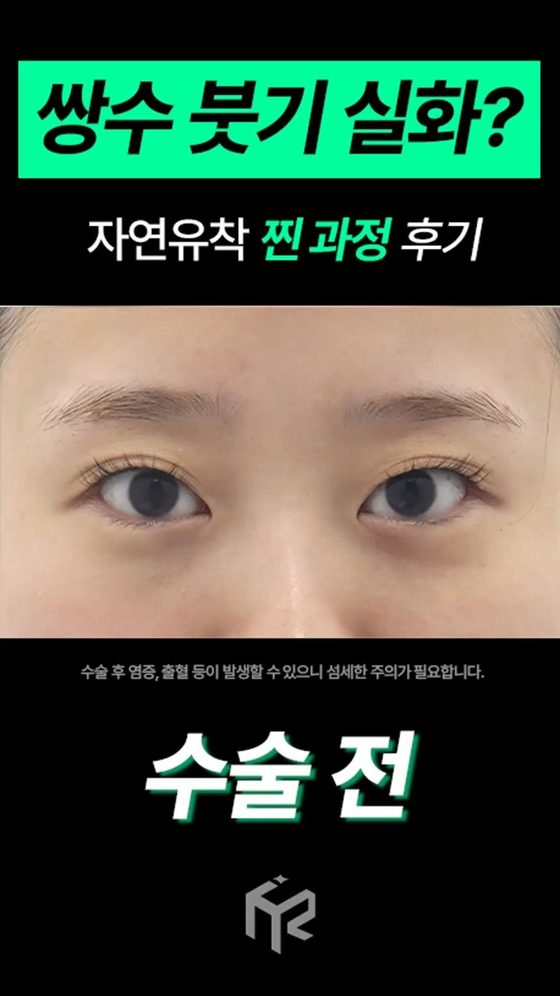 쌍수 붓기 실화? 자연유착 찐 과정 후기 / 수술 전 / 수술 후 염증, 출혈 등이 발생할 수 있으니 섬세한 주의가 필요합니다.