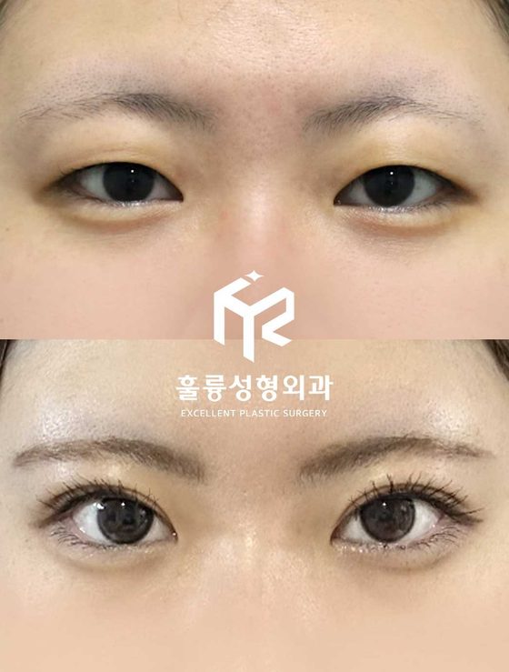 수술 전후 눈 사진(가운데 훌륭성형외과 로고) — 그림 속 글 없음