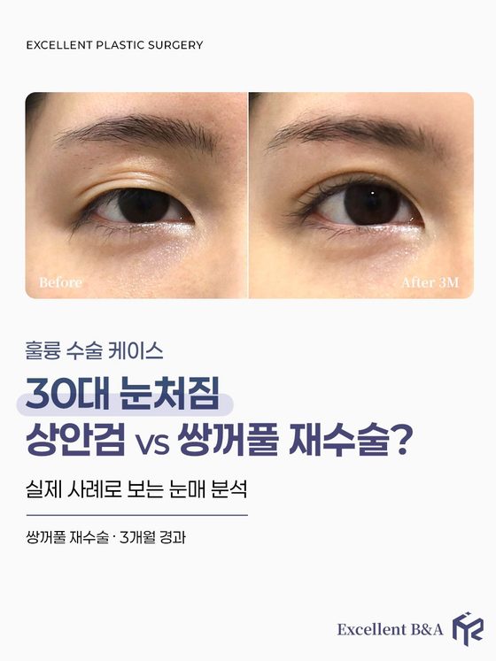 훌륭 수술 케이스 — 30대 눈처짐 상안검 vs 쌍꺼풀 재수술? / 실제 사례로 보는 눈매 분석 / 쌍꺼풀 재수술 · 3개월 경과 / Before · After 3M / Excellent B&A