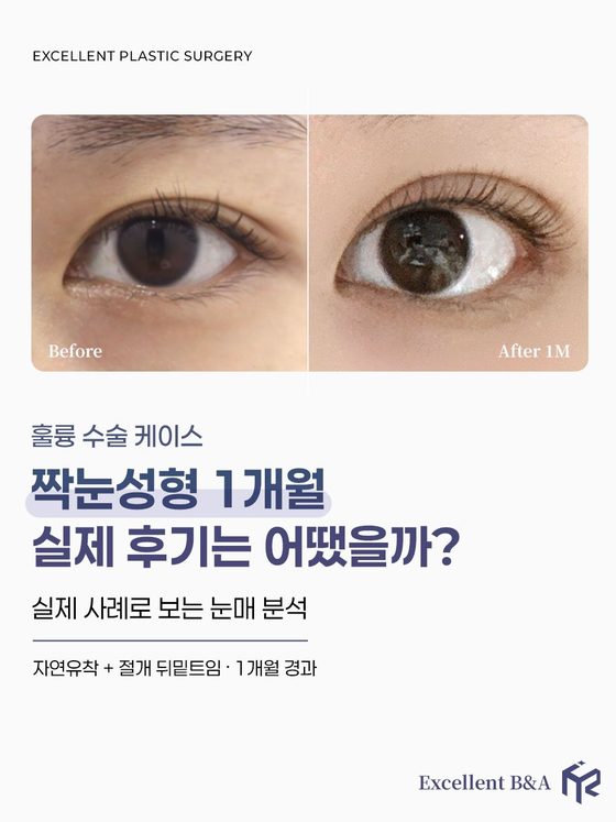 훌륭 수술 케이스 — 짝눈성형 1개월 실제 후기는 어땠을까? / 실제 사례로 보는 눈매 분석 / 자연유착 + 절개 뒤밑트임 · 1개월 경과 / Before · After 1M / Excellent B&A