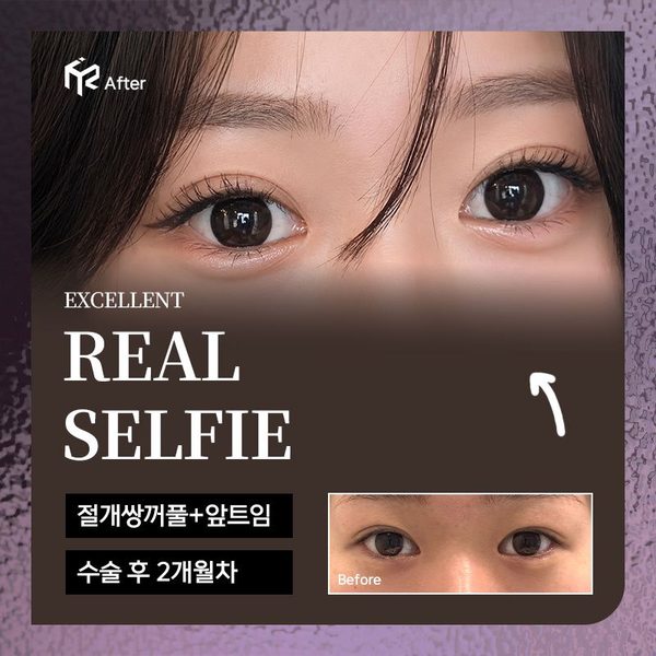 REAL SELFIE — 절개쌍꺼풀+앞트임 수술 후 2개월차(After 큰 사진 + Before 작은 사진)