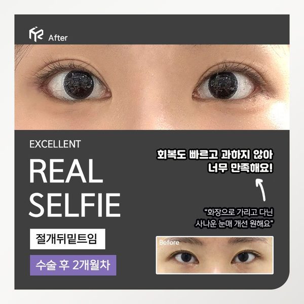 REAL SELFIE — 절개뒤밑트임 수술 후 2개월차(After 큰 사진 + Before 작은 사진)