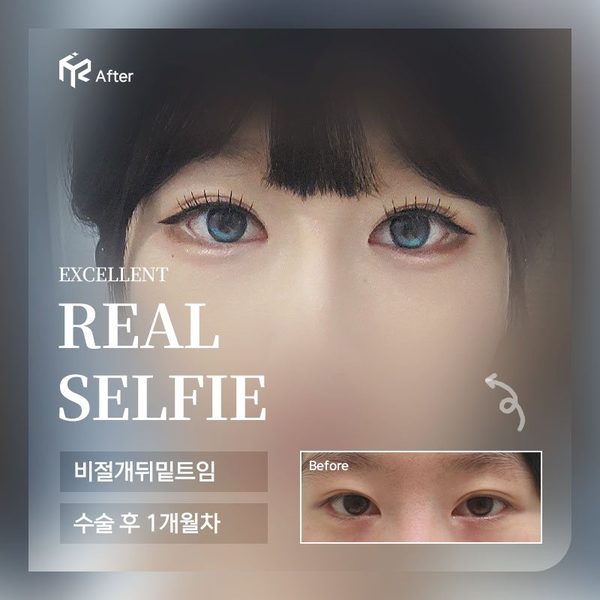 REAL SELFIE — 비절개뒤밑트임 수술 후 1개월차(After 큰 사진 + Before 작은 사진)