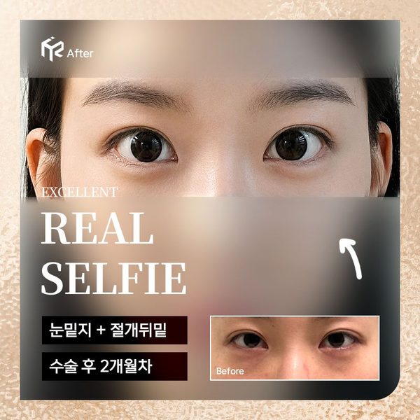 REAL SELFIE — 눈밑지 + 절개뒤밑 수술 후 2개월차(After 큰 사진 + Before 작은 사진)